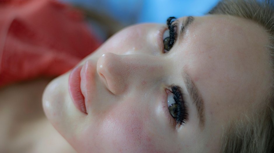 여드름 - 이미지