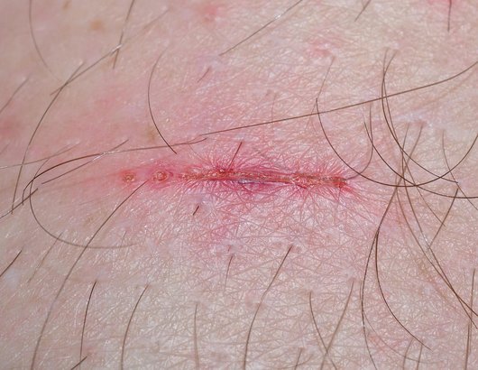 상처관리 - 이미지